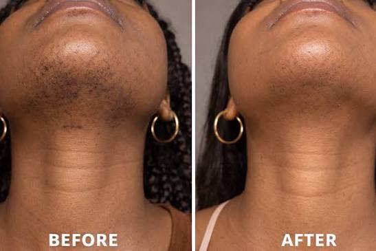 Facial Hair Removal Cream